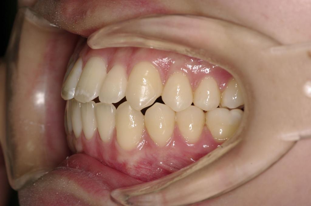 前歯、出っ歯・開咬の矯正治療後口内写真NO.1001