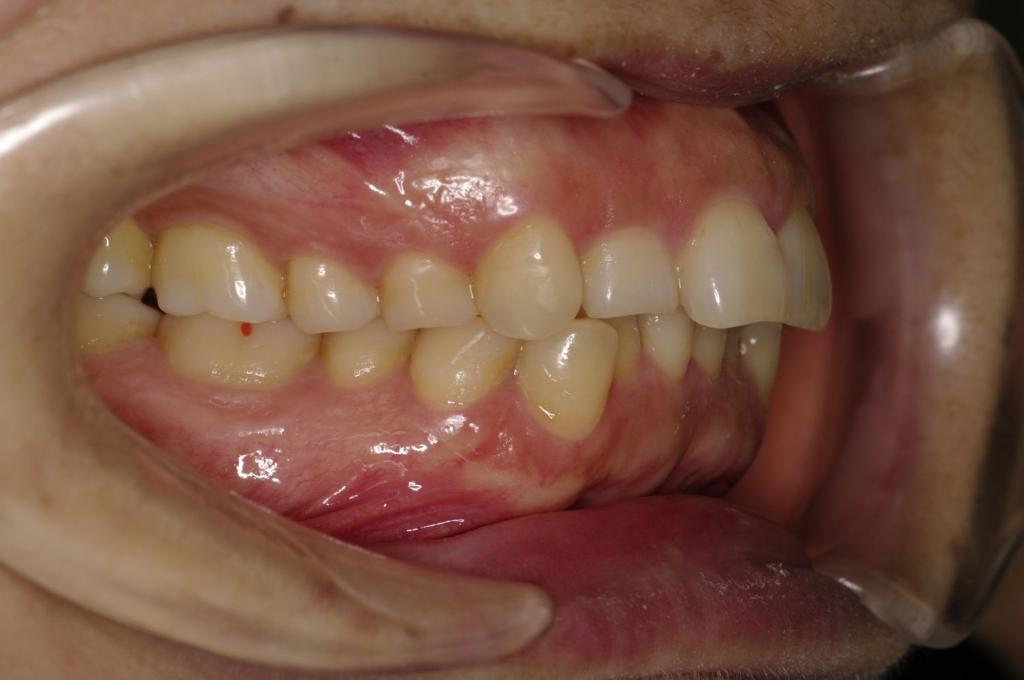 前歯、出っ歯・開咬の矯正治療前口内写真NO.1002