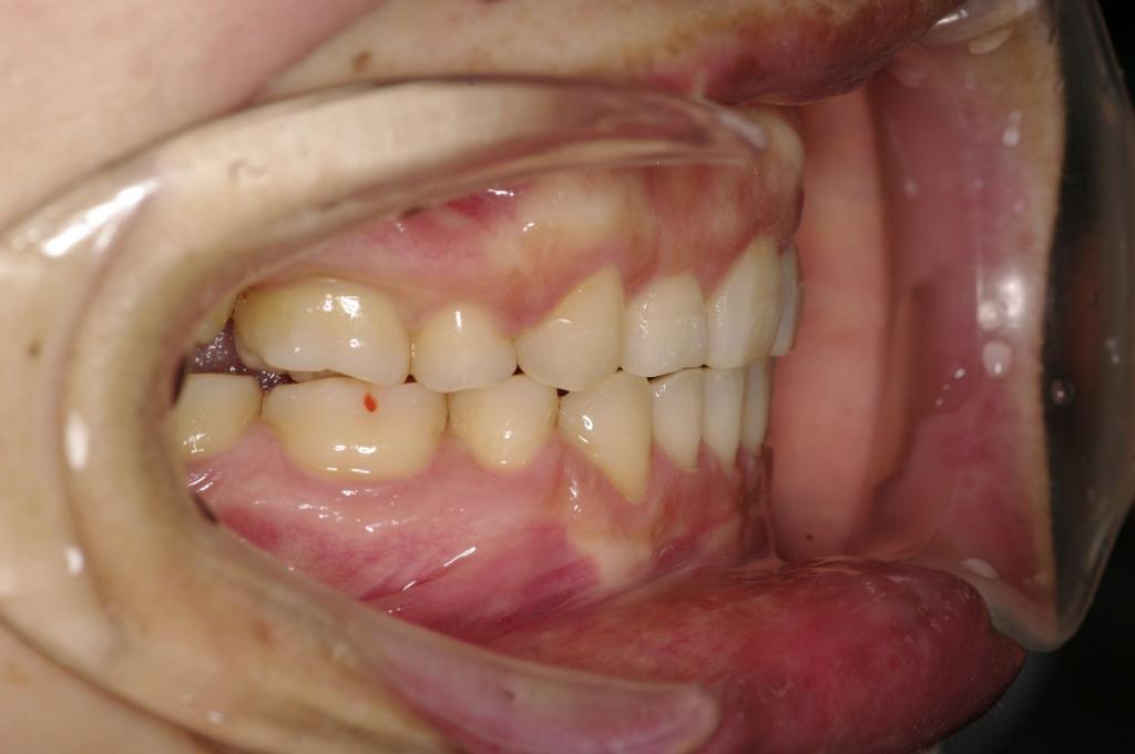 前歯、出っ歯・開咬の矯正治療後口内写真NO.1002