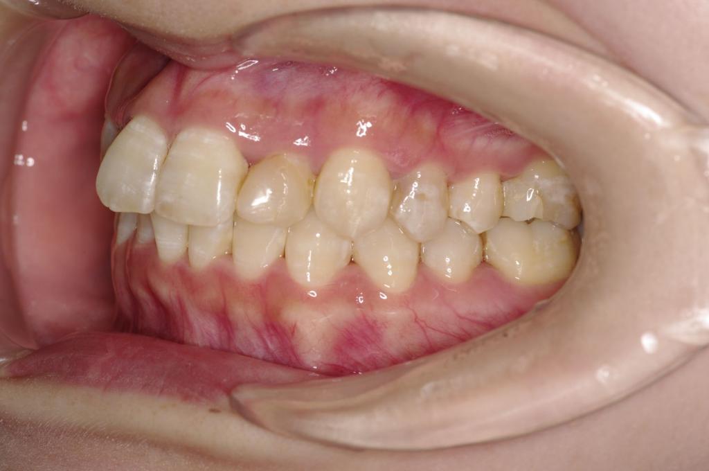 前歯、出っ歯・開咬の矯正治療前口内写真NO.1003