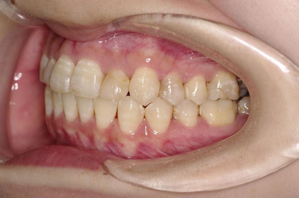 前歯、出っ歯・開咬の矯正治療後口内写真NO.1003