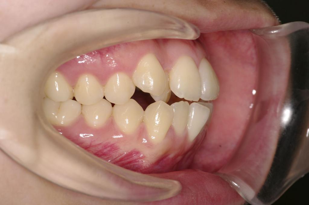 前歯、出っ歯・開咬の矯正治療前口内写真NO.1004