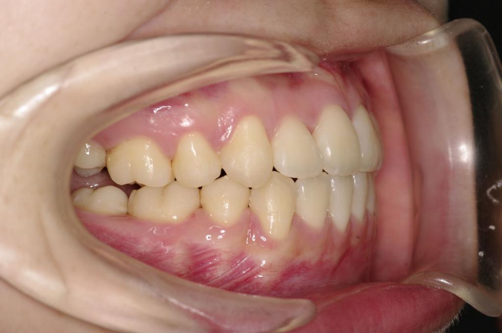 前歯、出っ歯・開咬の矯正治療後口内写真NO.1004