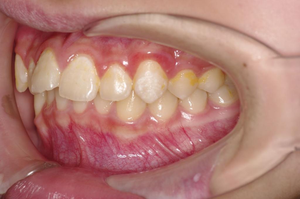 前歯、出っ歯・開咬の矯正治療前口内写真NO.1005