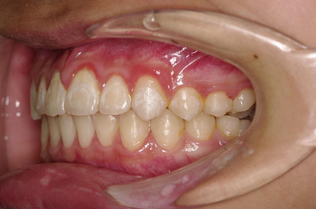前歯、出っ歯・開咬の矯正治療後口内写真NO.1005