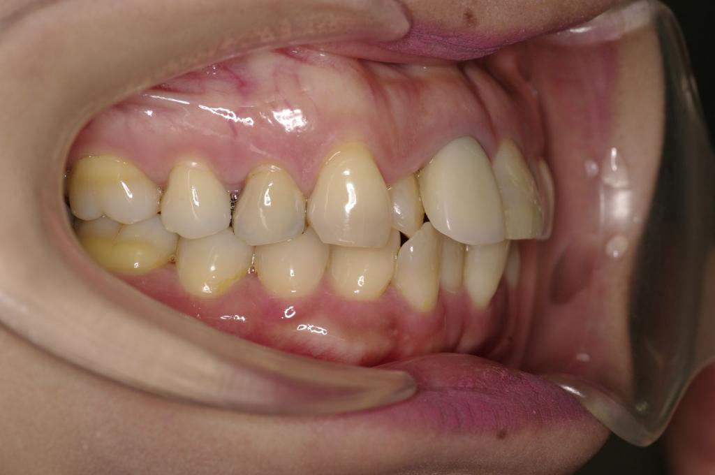 前歯、出っ歯・開咬の矯正治療前口内写真NO.1006