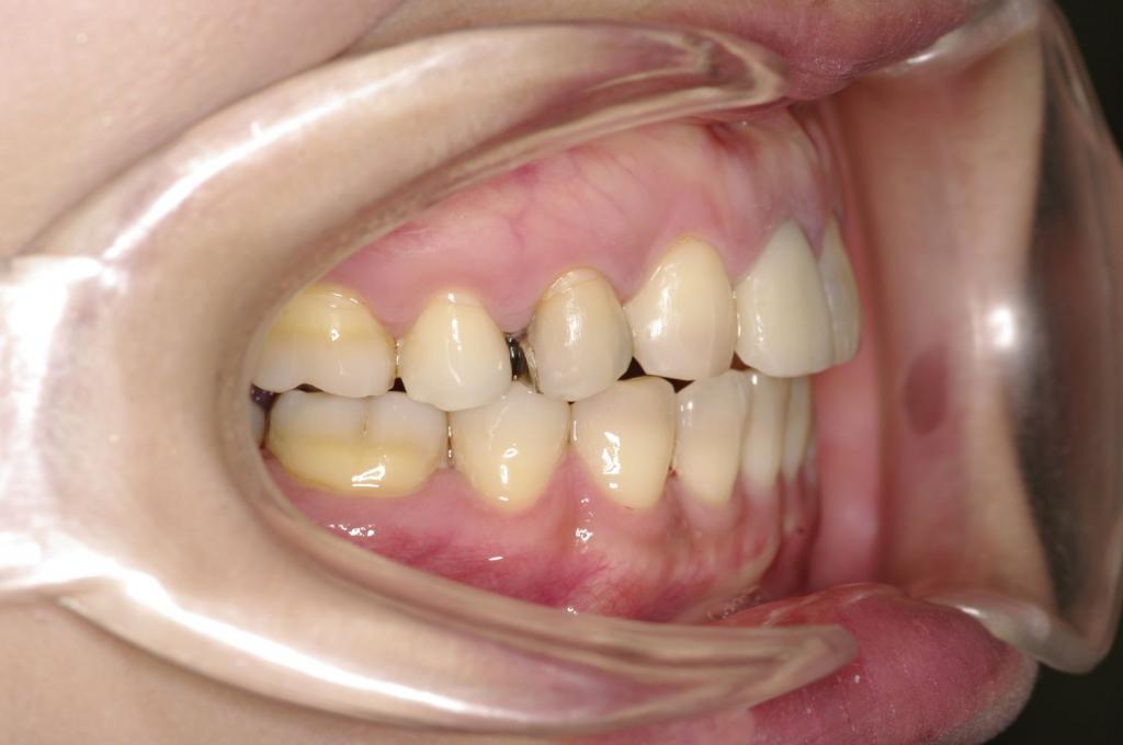 前歯、出っ歯・開咬の矯正治療後口内写真NO.1006
