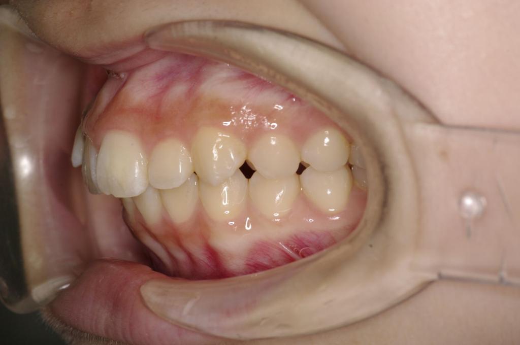前歯、出っ歯・開咬の矯正治療前口内写真NO.1007