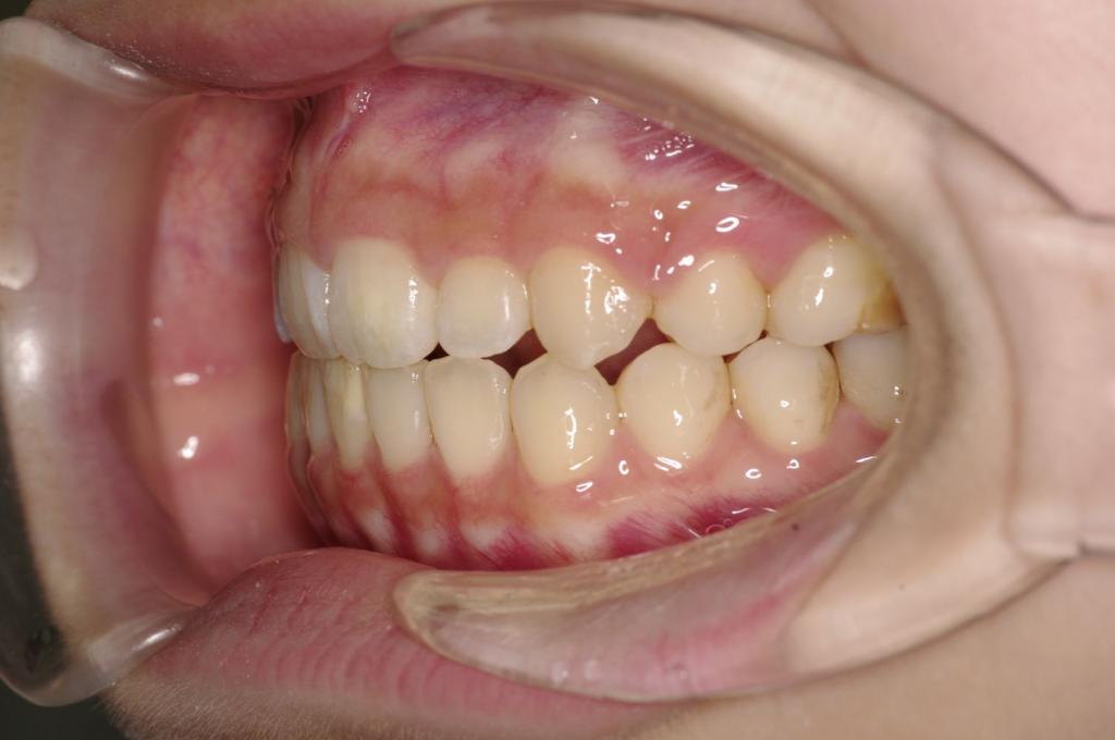 前歯、出っ歯・開咬の矯正治療後口内写真NO.1007