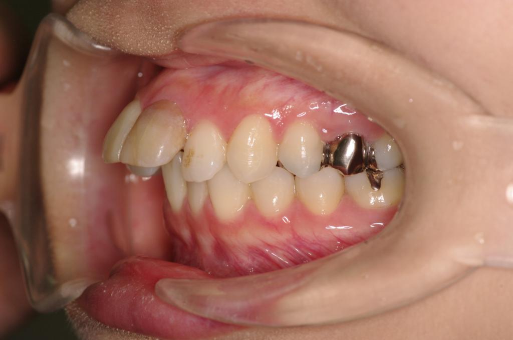 前歯、出っ歯・開咬の矯正治療前口内写真NO.1008