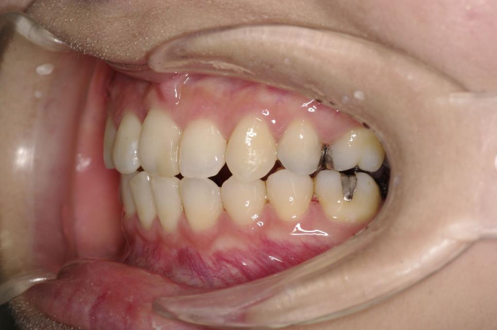 前歯、出っ歯・開咬の矯正治療後口内写真NO.1008