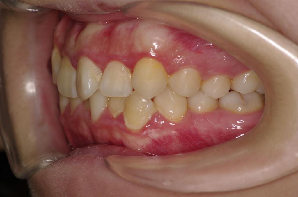 前歯、出っ歯・開咬の矯正治療前口内写真NO.1009