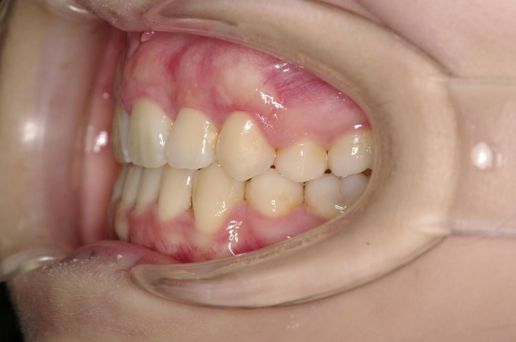 前歯、出っ歯・開咬の矯正治療後口内写真NO.1009
