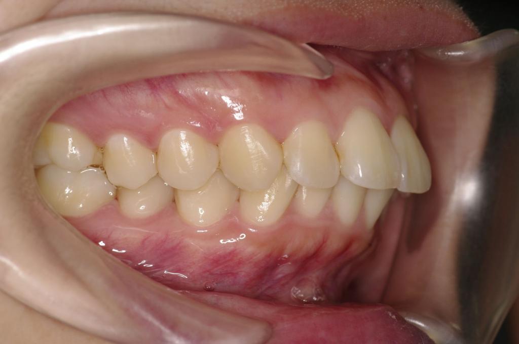 前歯、出っ歯・開咬の矯正治療前口内写真NO.1010