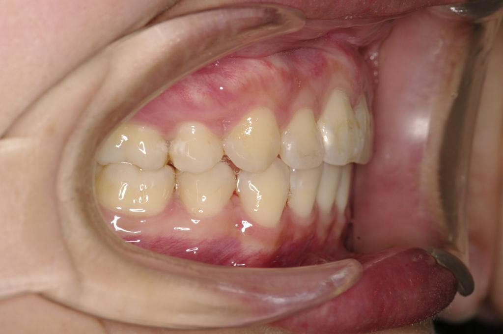 前歯、出っ歯・開咬の矯正治療後口内写真NO.1010