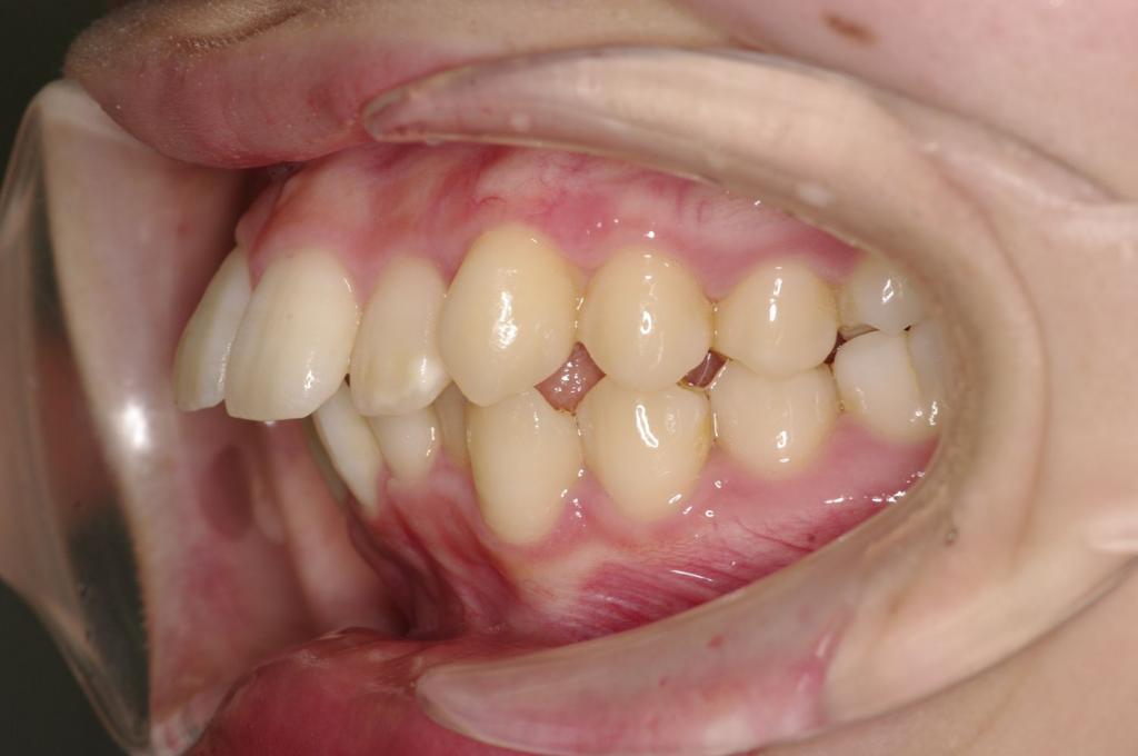前歯、出っ歯・開咬の矯正治療前口内写真NO.1011