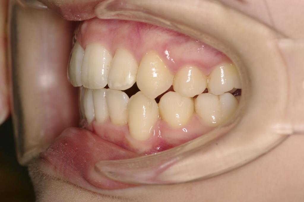 前歯、出っ歯・開咬の矯正治療後口内写真NO.1011