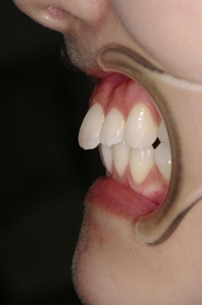 前歯、出っ歯・開咬の矯正治療前口内写真NO.1012