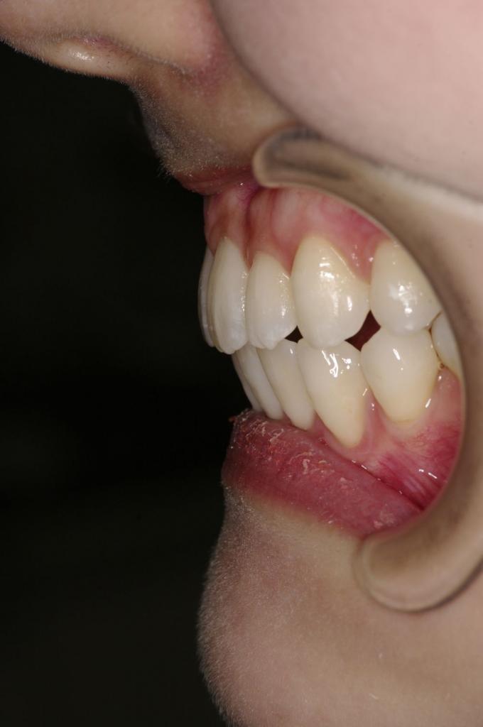 前歯、出っ歯・開咬の矯正治療後口内写真NO.1012