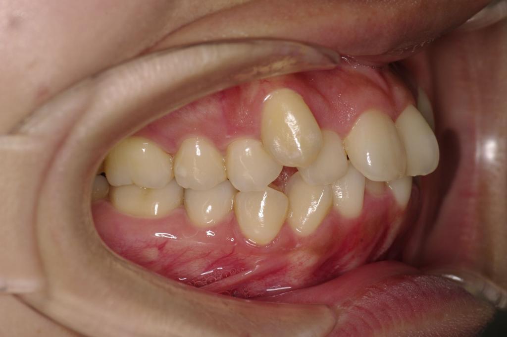 前歯、出っ歯・開咬の矯正治療前口内写真NO.1013