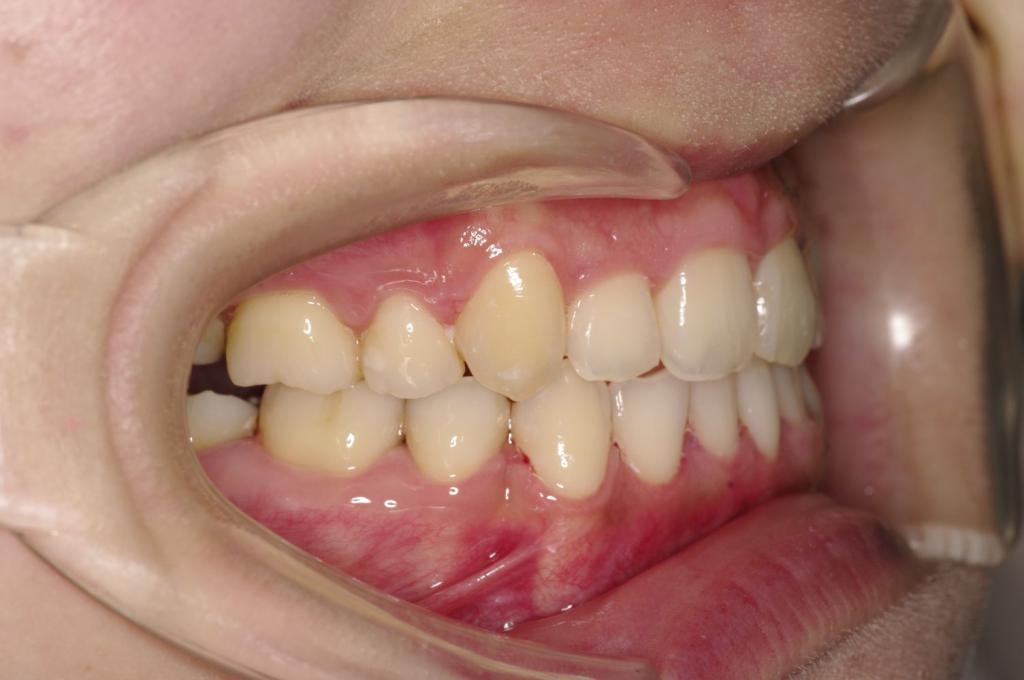 前歯、出っ歯・開咬の矯正治療後口内写真NO.1013