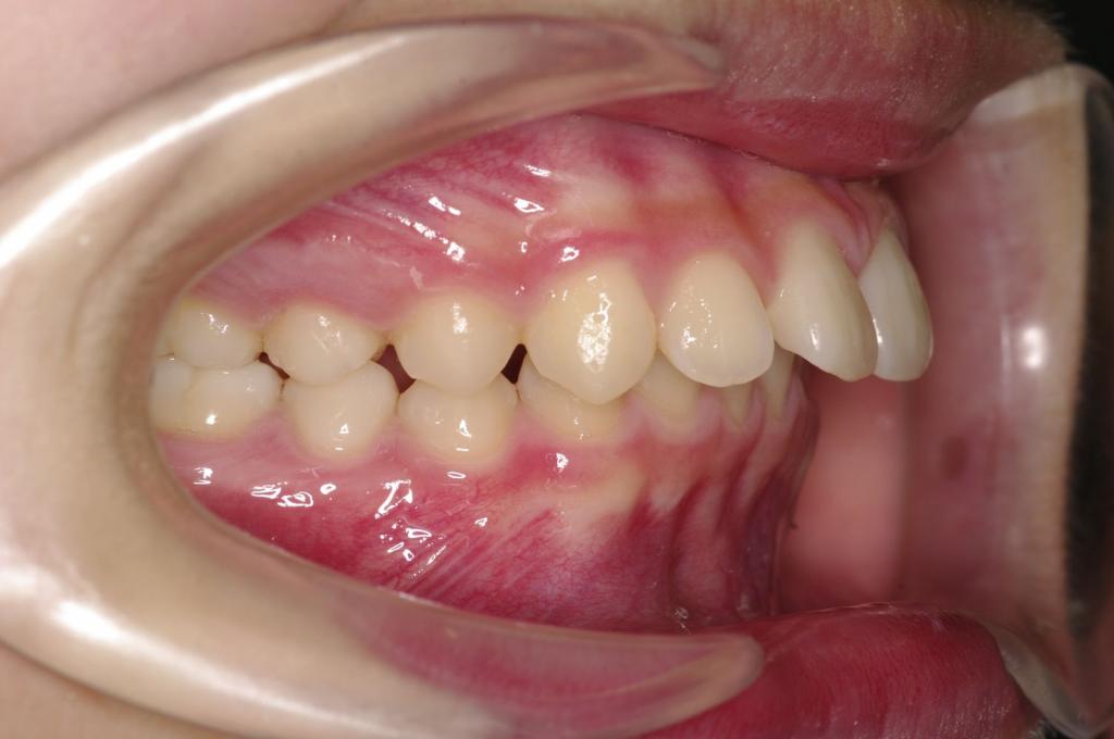 前歯、出っ歯・開咬の矯正治療前口内写真NO.1014