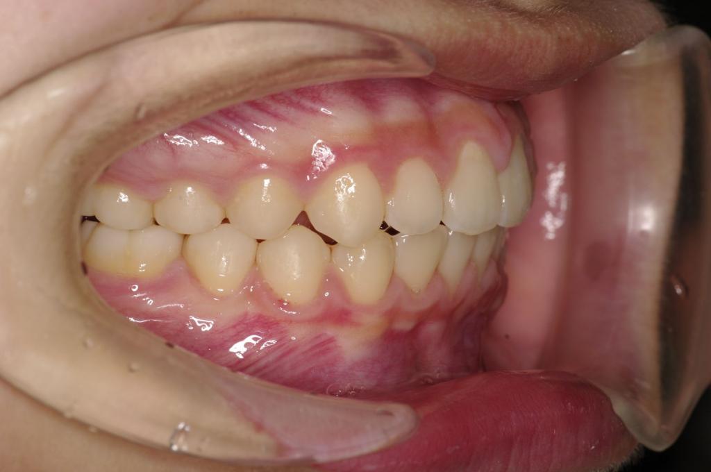 前歯、出っ歯・開咬の矯正治療後口内写真NO.1014