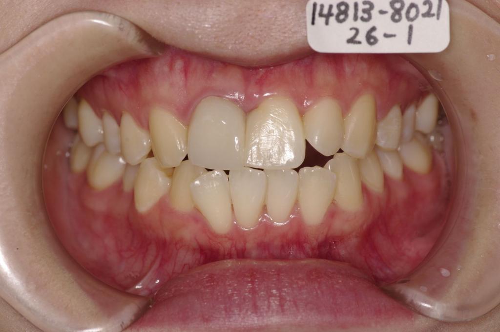 前歯、出っ歯・開咬の矯正治療前口内写真NO.1015