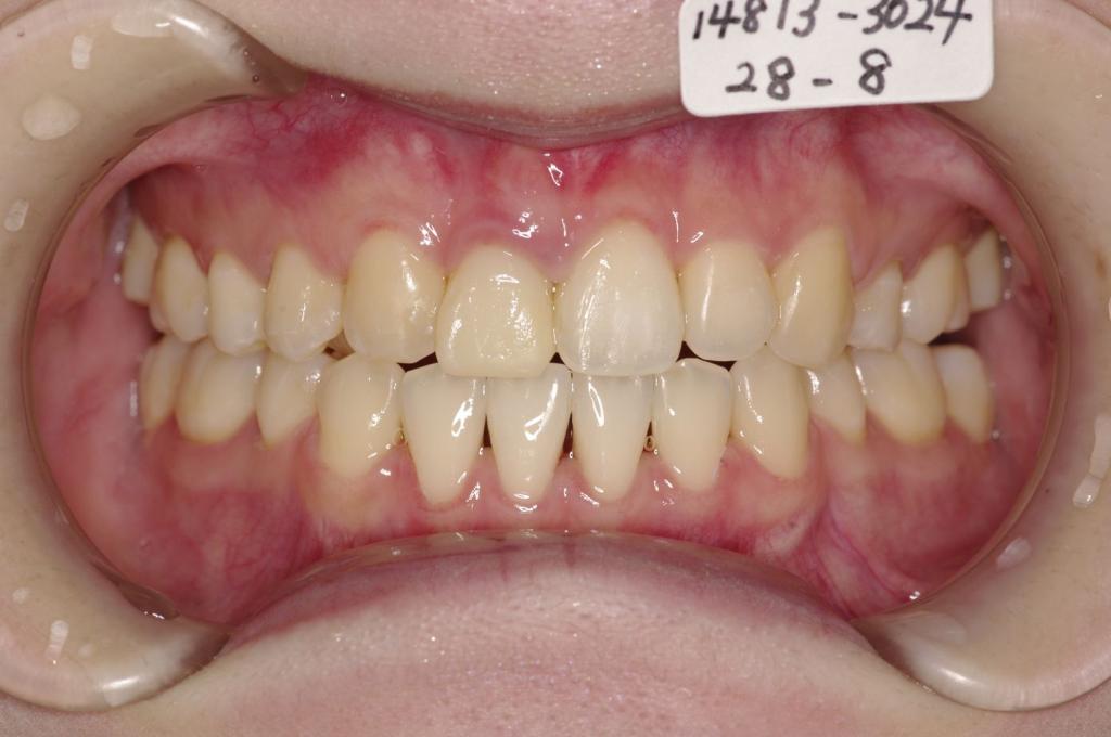 前歯、出っ歯・開咬の矯正治療後口内写真NO.1015