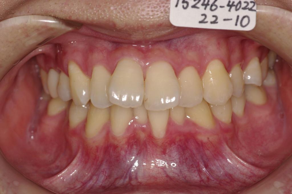 前歯、出っ歯・開咬の矯正治療前口内写真NO.1016