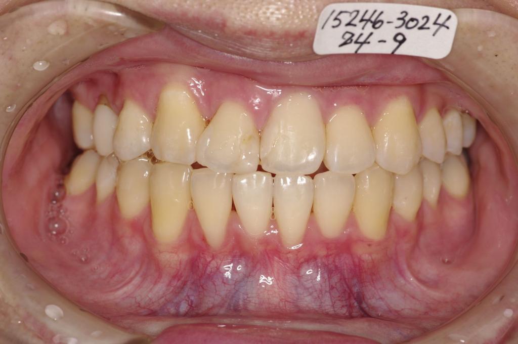 前歯、出っ歯・開咬の矯正治療後口内写真NO.1016