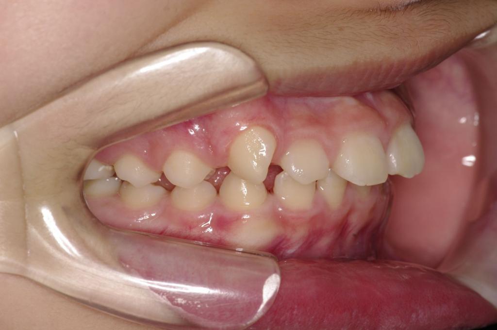 前歯、出っ歯・開咬の矯正治療前口内写真NO.1017