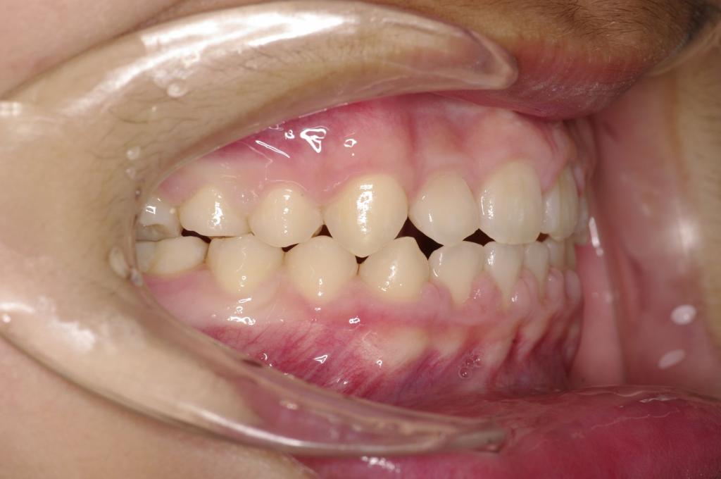 前歯、出っ歯・開咬の矯正治療後口内写真NO.1017