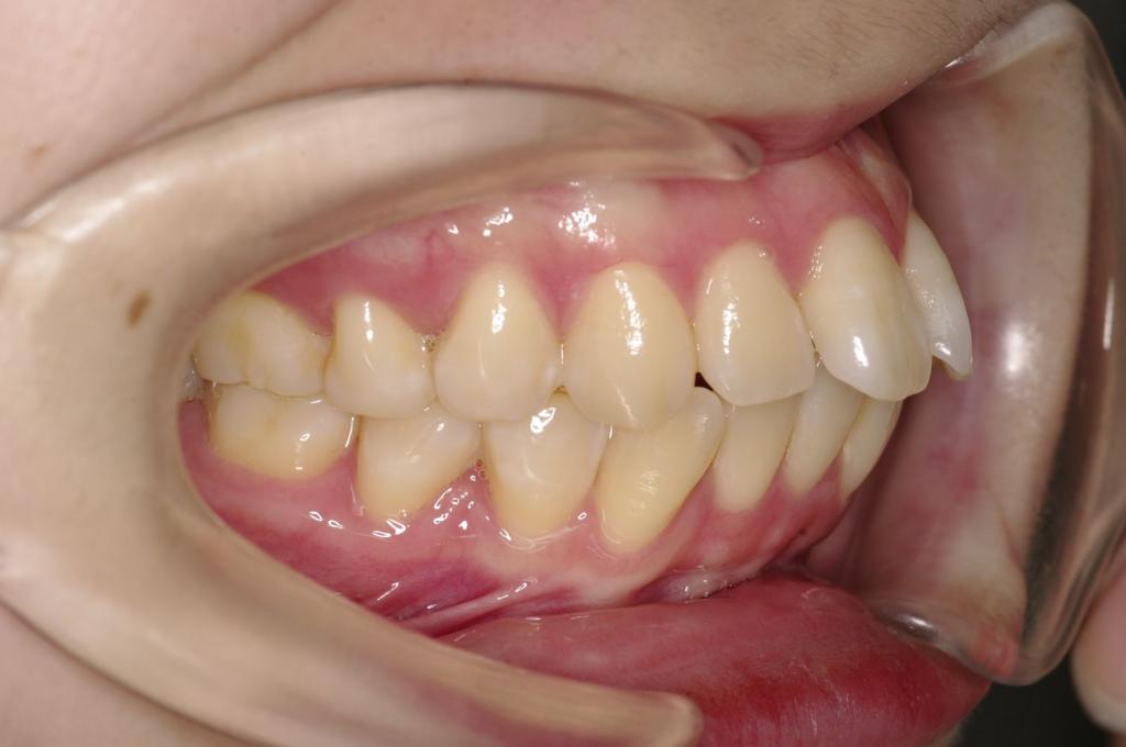 前歯、出っ歯・開咬の矯正治療前口内写真NO.1018