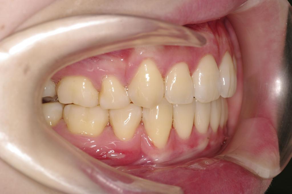 前歯、出っ歯・開咬の矯正治療後口内写真NO.1018