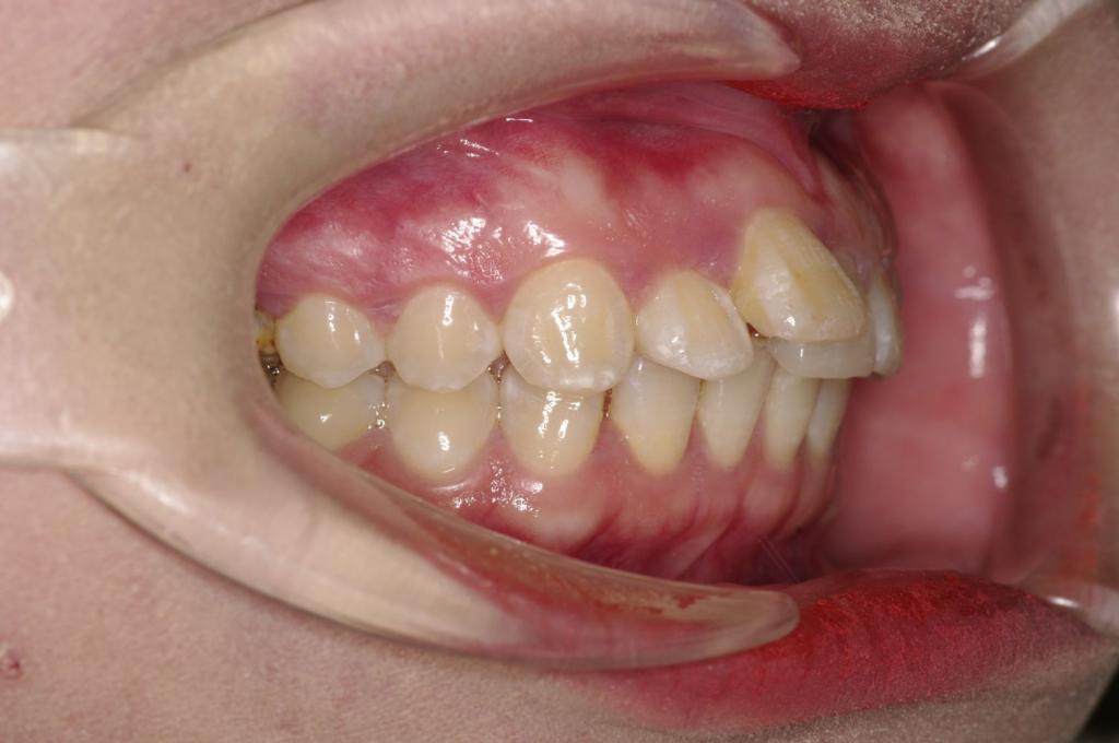 前歯、出っ歯・開咬の矯正治療前口内写真NO.1019