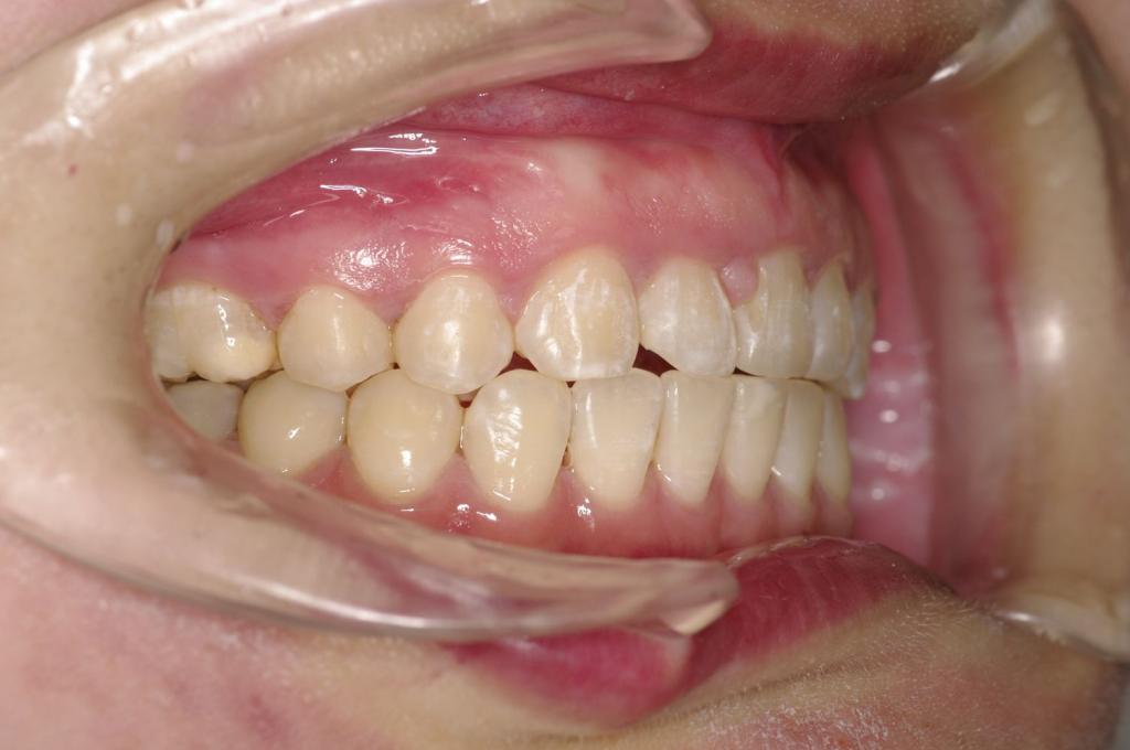 前歯、出っ歯・開咬の矯正治療後口内写真NO.1019