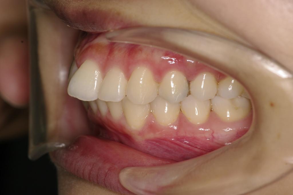 前歯、出っ歯・開咬の矯正治療前口内写真NO.975