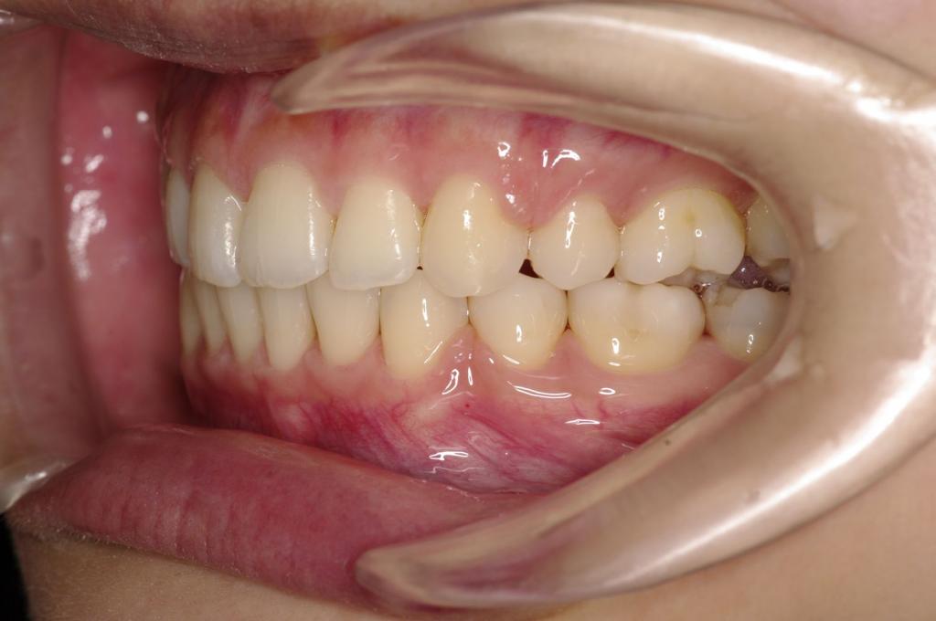前歯、出っ歯・開咬の矯正治療後口内写真NO.975