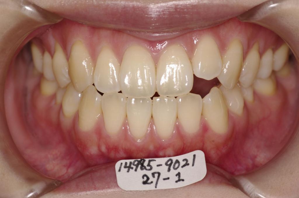 前歯、出っ歯・開咬の矯正治療前口内写真NO.976