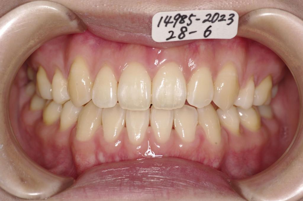 前歯、出っ歯・開咬の矯正治療後口内写真NO.976