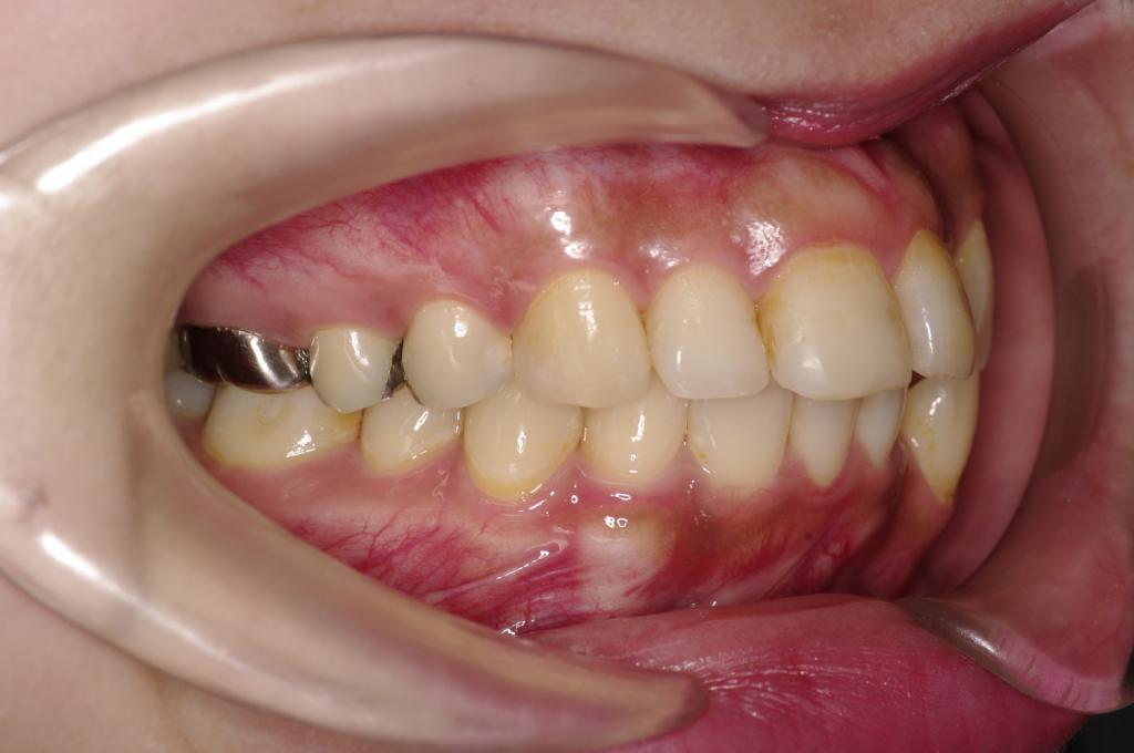 前歯、出っ歯・開咬の矯正治療前口内写真NO.977
