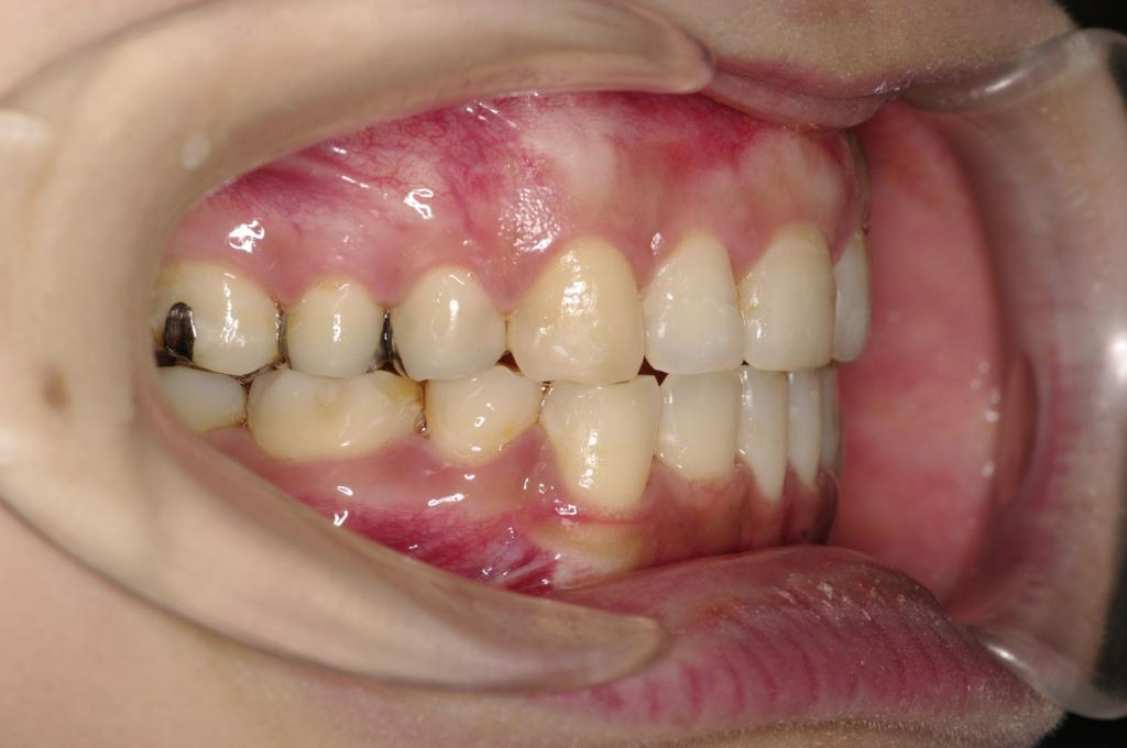 前歯、出っ歯・開咬の矯正治療後口内写真NO.977