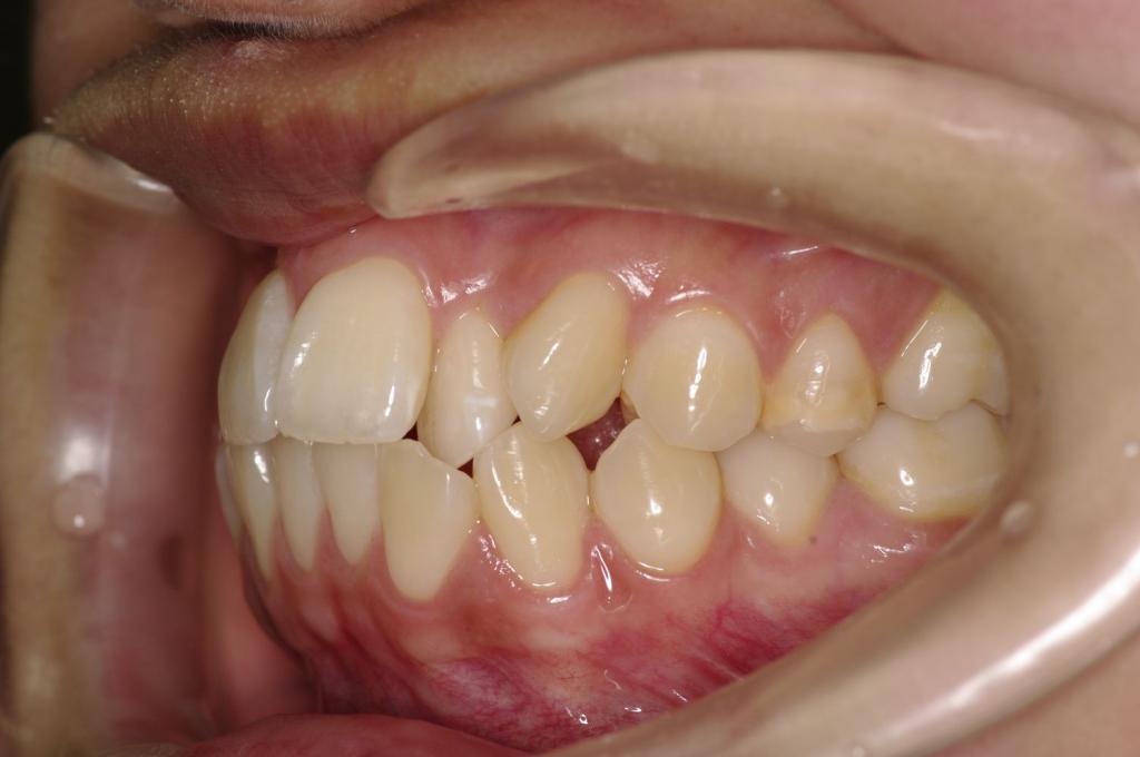 前歯、出っ歯・開咬の矯正治療前口内写真NO.978