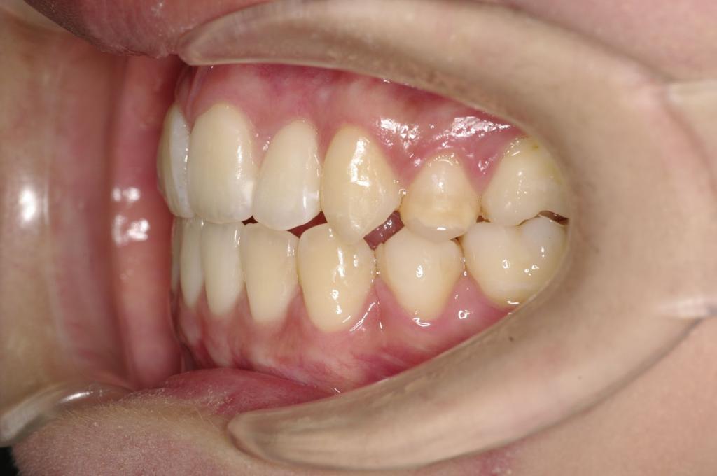 前歯、出っ歯・開咬の矯正治療後口内写真NO.978