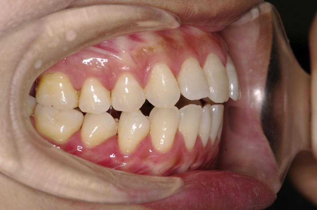 前歯、出っ歯・開咬の矯正治療前口内写真NO.979