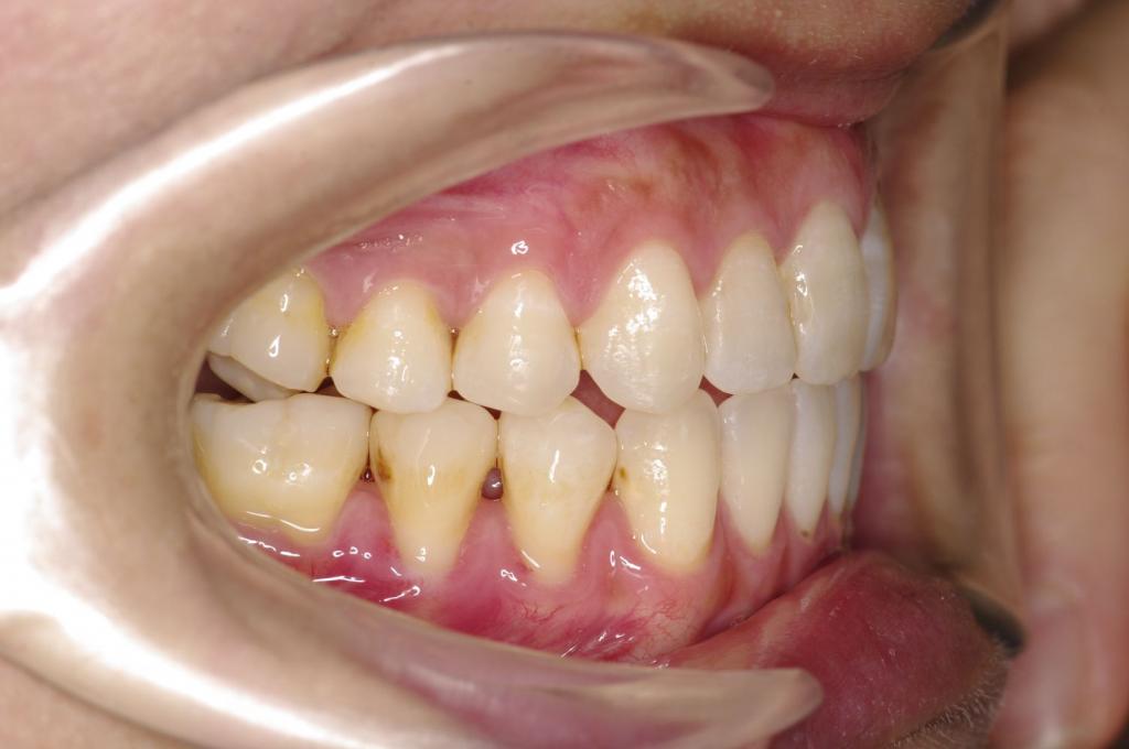 前歯、出っ歯・開咬の矯正治療後口内写真NO.979