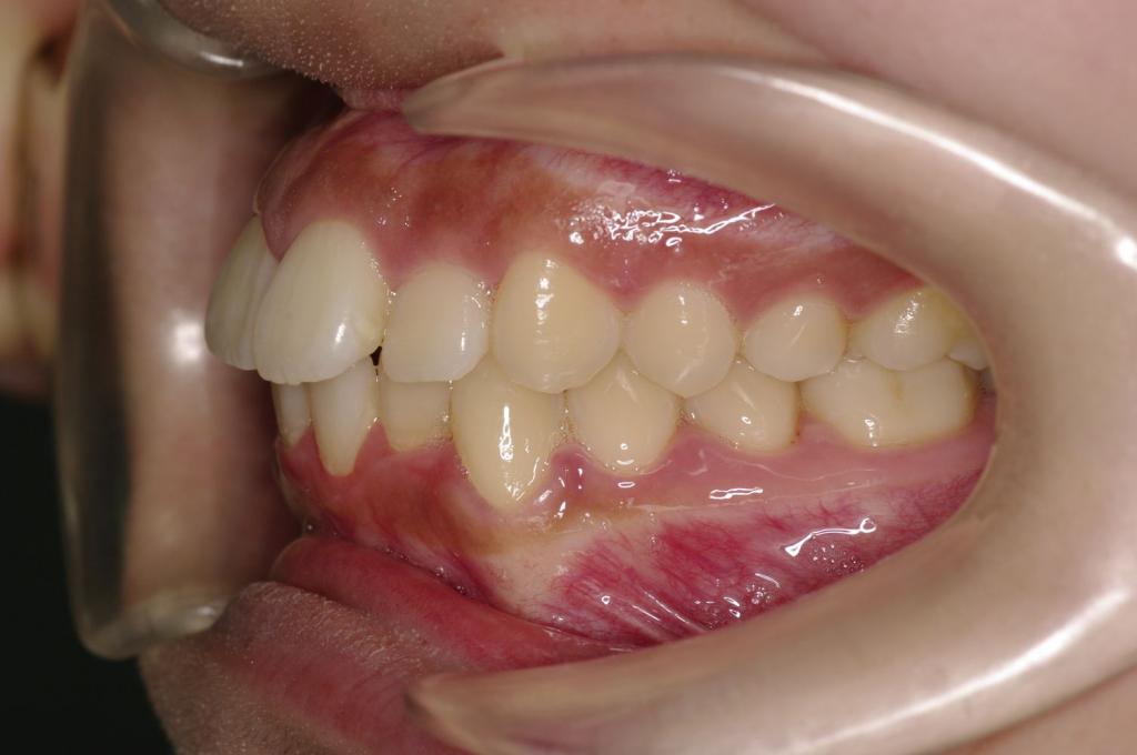 前歯、出っ歯・開咬の矯正治療前口内写真NO.980