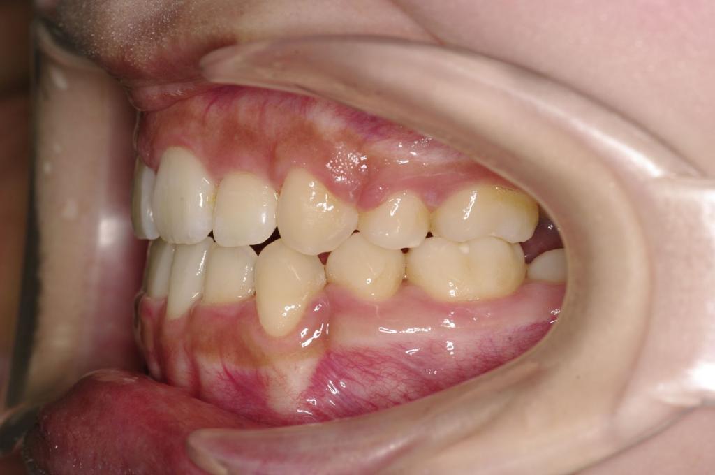 前歯、出っ歯・開咬の矯正治療後口内写真NO.980