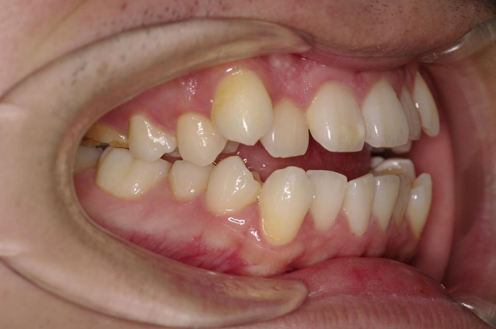 前歯、出っ歯・開咬の矯正治療前口内写真NO.981